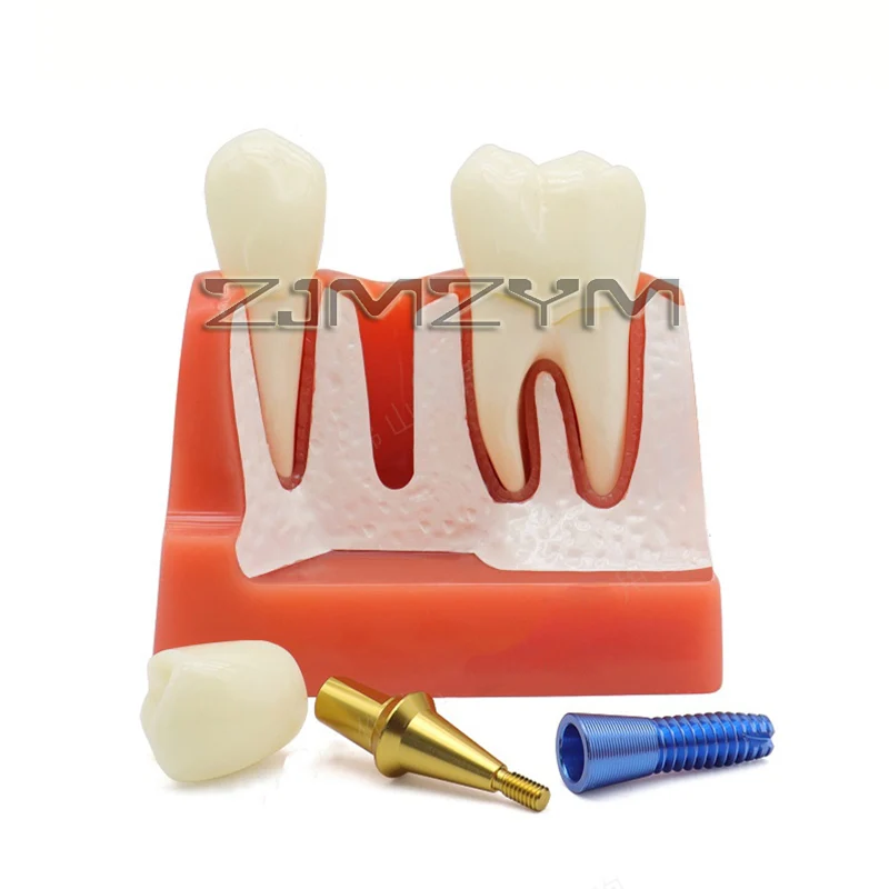 Dental 4 Times Implant Teeth Model Analysis Crown Bridge Removable Model Dental Demonstration Teeth Model Dentisty Study