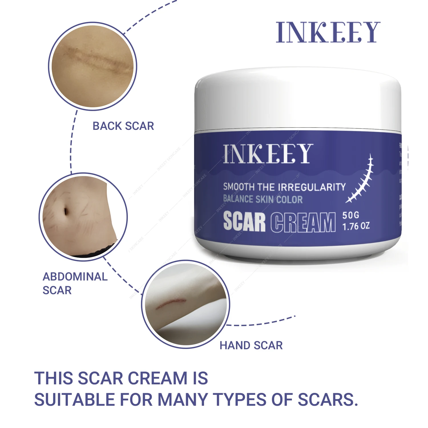 Scar Removal Cream Fade Acne Scar Spots Treatment Stretch Marks Burn Surgical Scar Repairing Cream New Old Scars Gel Skin Care