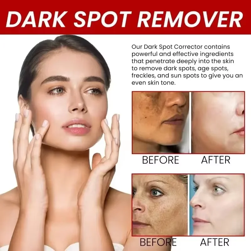 Powerful Spot-removing Whiten Cream Against Pigment Spots Brighten Skin Fade Stain Melanin Moisturize Beauty Korean Skin Care