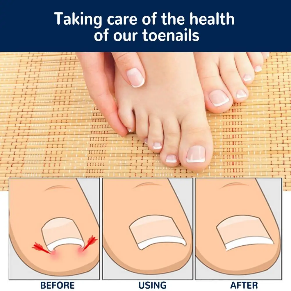 Ultra Thin 50Pcs/Set Universal New Ingrown Toenail Corrector Sticker Breathable Toenail Patches Elastic Plate   for Walk