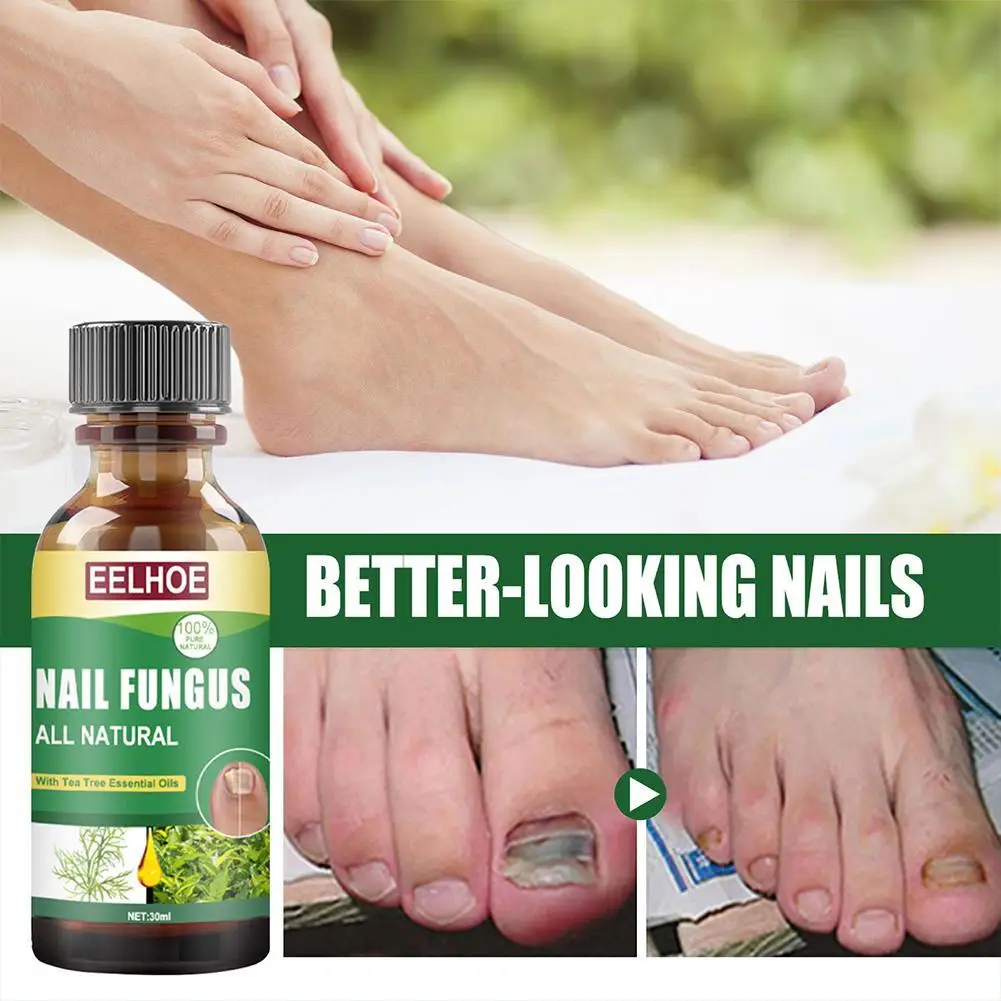 Nail Fungal Treatment Care Essence Nail Foot Whitening Removal Paronychia Anti Infection Gel Fungus Nails Onychomycosis K3M7