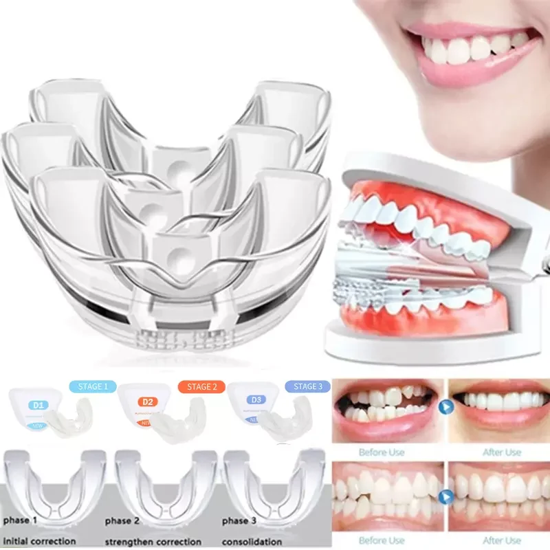 

3 Stages Dental Orthodontic Braces Alignment Trainer Teeth Retainer Bruxism Mouth Guard Teeth Straightener Braces Appliance