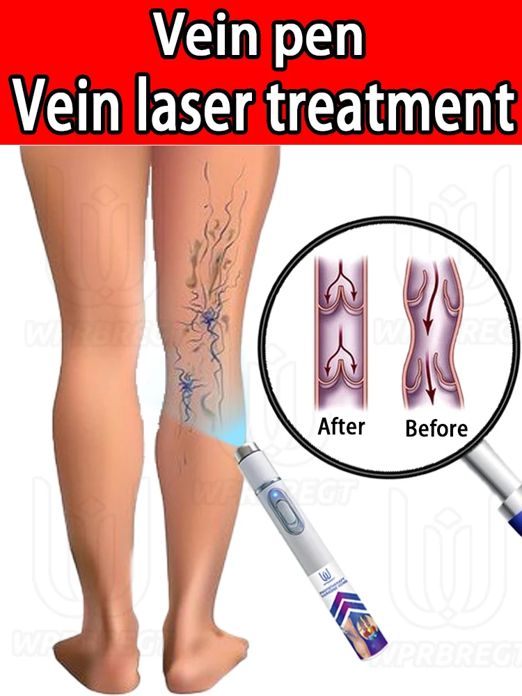 

The second generation blue light laser pen effectively relieves leg dilated vasculitis and eliminates varicose veins, and can he
