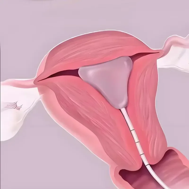 Seemine Intrauterine Balloon Uterine Stent PC Silicone Paper PE Materials for Placement Following Procedure