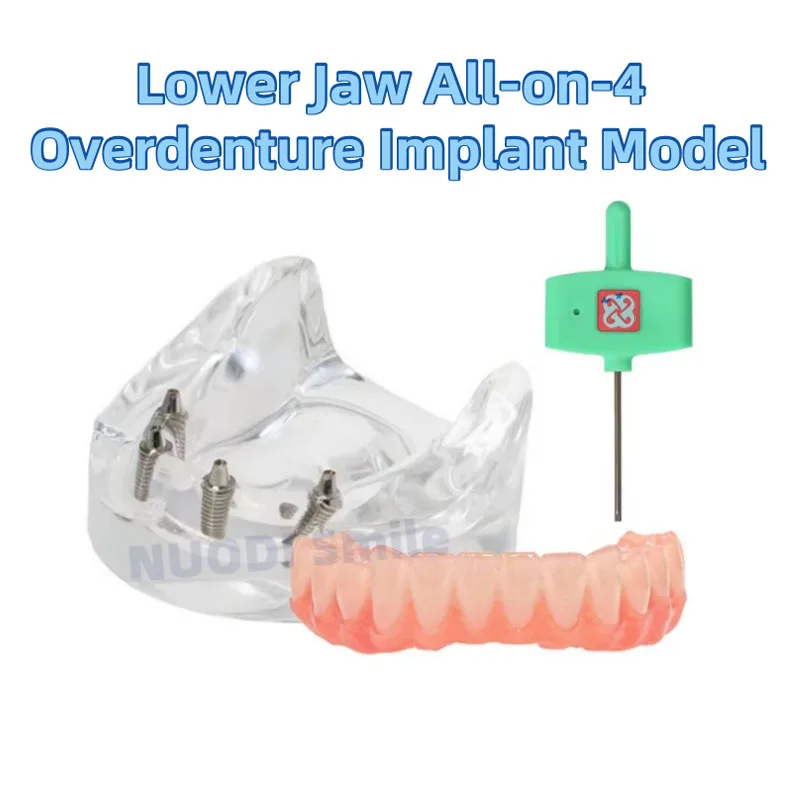 Dental Implant Lower Jaw Restoration Teeth Model All-on-4 Overdenture Model 4 Screws with Post Core Bridge Dentistry Study Model