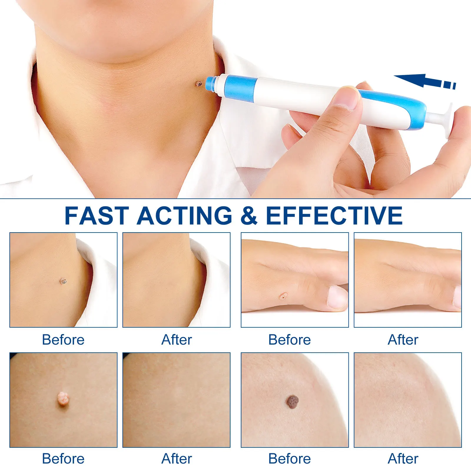 Kit de eliminación automática de etiquetas de piel 2 en 1 para etiquetas de piel pequeñas y grandes, 1-9mm con hisopos de limpieza, herramienta de cuidado de la piel facial para uso doméstico