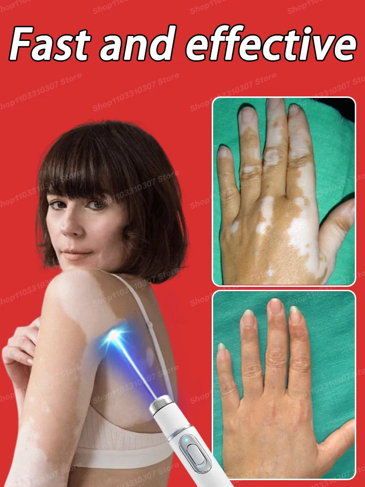 

Laser Technology Improve Vitiligo