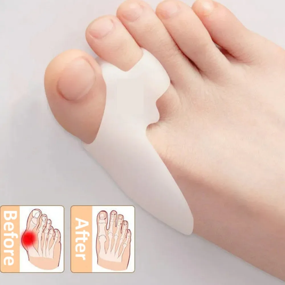 2Pcs Siliconen Gel Thumb Corrector Bunion Voet Teen Hallux Valgus Protector Separator Vinger Stijltang Richter Voetverzorging Tool