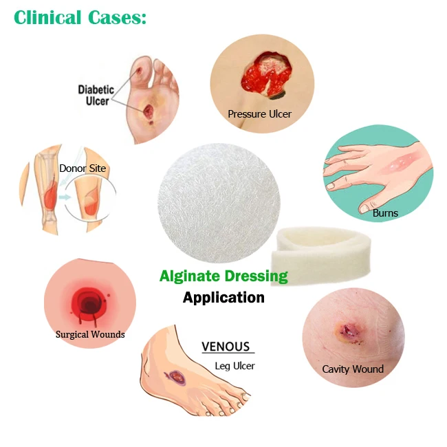 Medical Disposable Supplies for Wound Care Alginate Dressing with Silver Available 10x10cm Wound Therapy Dressing
