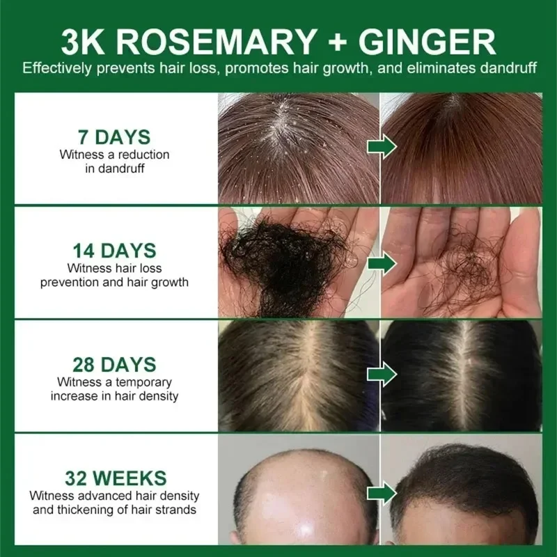 جوهر نمو الشعر السريع أفريقيا مجنون الجر الثعلبة مصل مكافحة كسر الشعر تخفيف القشرة وحكة فروة الرأس الشعر 30 مللي