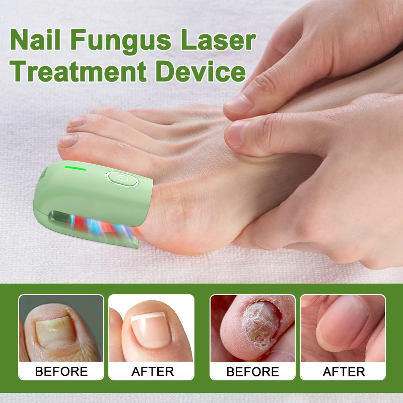 Fungal Nail Laser Treatment Device, Foot Nail Fungus Fast Remove Laser, Toenail Fingernails, No Pain, Physiotherapy for Nails