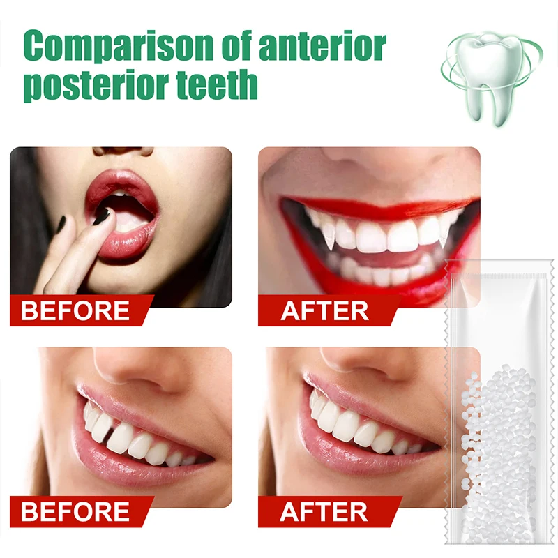 Pegamento de resina para reparación de dientes, relleno de huecos de dientes moldeables, temporal, sólido, suministros dentales de seguridad, 10-100g