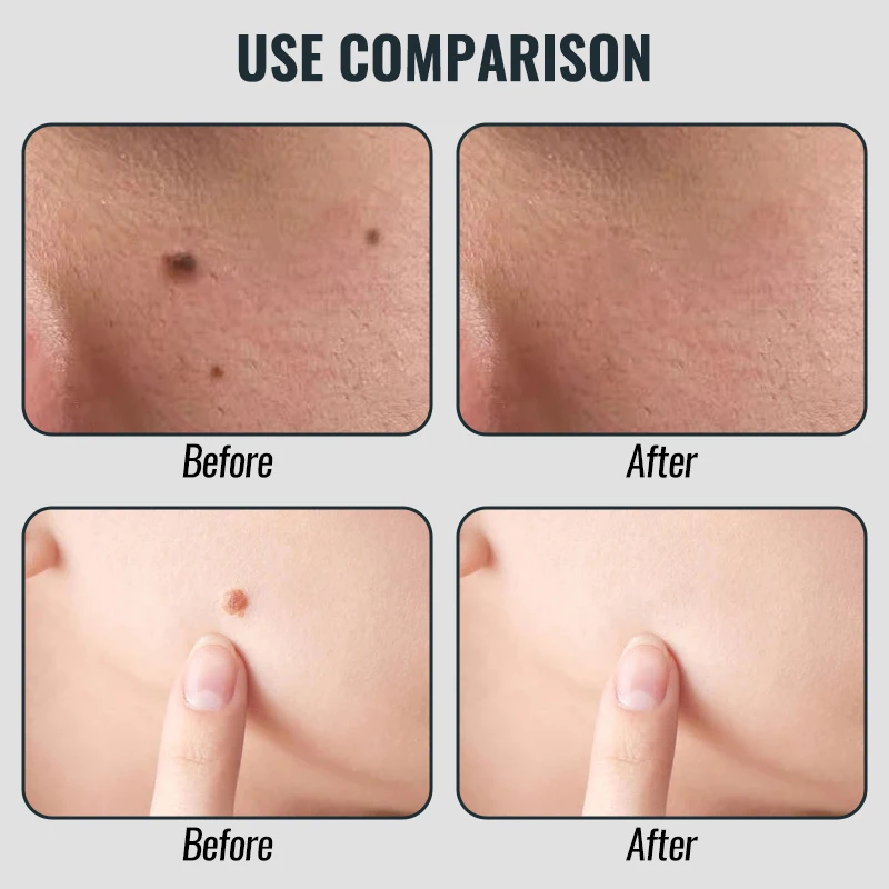 Tela lcd usb recarregável se livrar dos manilhas de fios substituível cabeça de trabalho caneta remoção toupeira 9 th nível branco