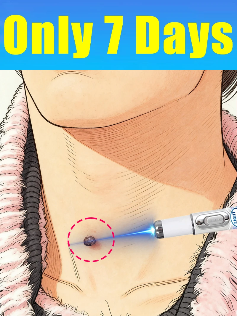 

2026NEW blue light pen to solve neck warts, hot wart care tools