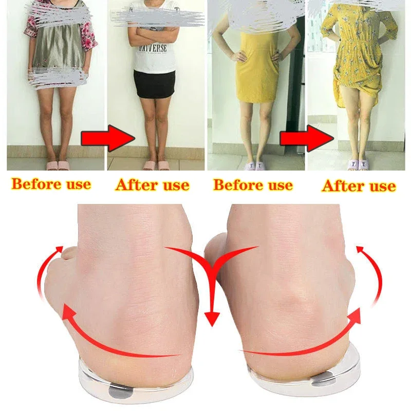 Silicone Orthopedic Insole for Feet O/X Leg Type Valgus Varus Correction Plantar Fasciitis Gel Heel Pad Magnet Massage Foot Care image 3