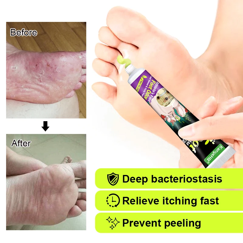 1pcs Foot Itch Cream Herbal Extract Repair Foot Skin Removal Odor Psoriasis Anti-skin Inhibitory Fungus Tinea Pedis Cream G027