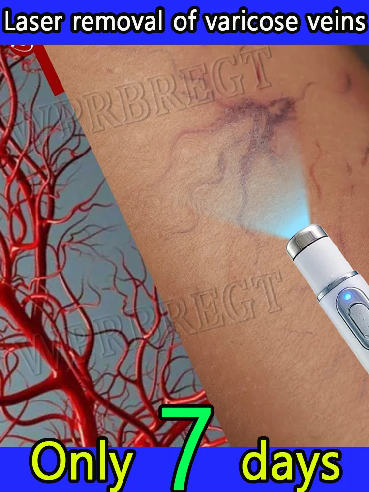 

Rapid laser removal of varicose veins phlebitis venous dilatation spider legs