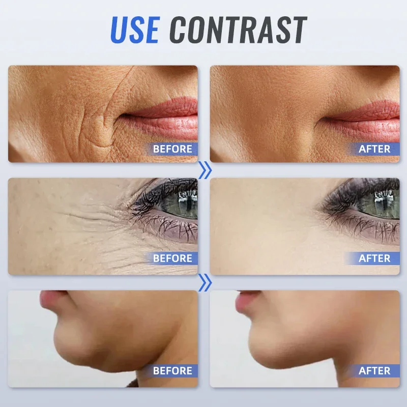 EMS Mini HIFU Gesichts Ultraschall Lifting Schönheit Meter Gesichts Lifting Straffende Falten Massager Gesichts Pflege Schönheit Werkzeuge hautpflege