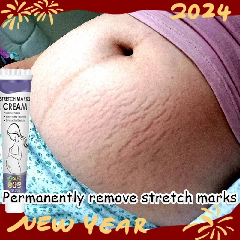 

Stretch Mark Removal Cream Permanently Removes Stretch Marks Rejuvenates Skin Stretch Mark Removal Cream