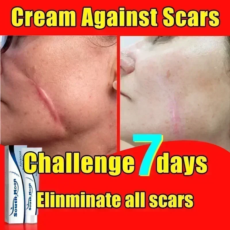 حفر حب الشباب علامات التمدد ، إزالة الندبات القديمة ، الإصلاح الفعال ، الجراحة ، Scars090