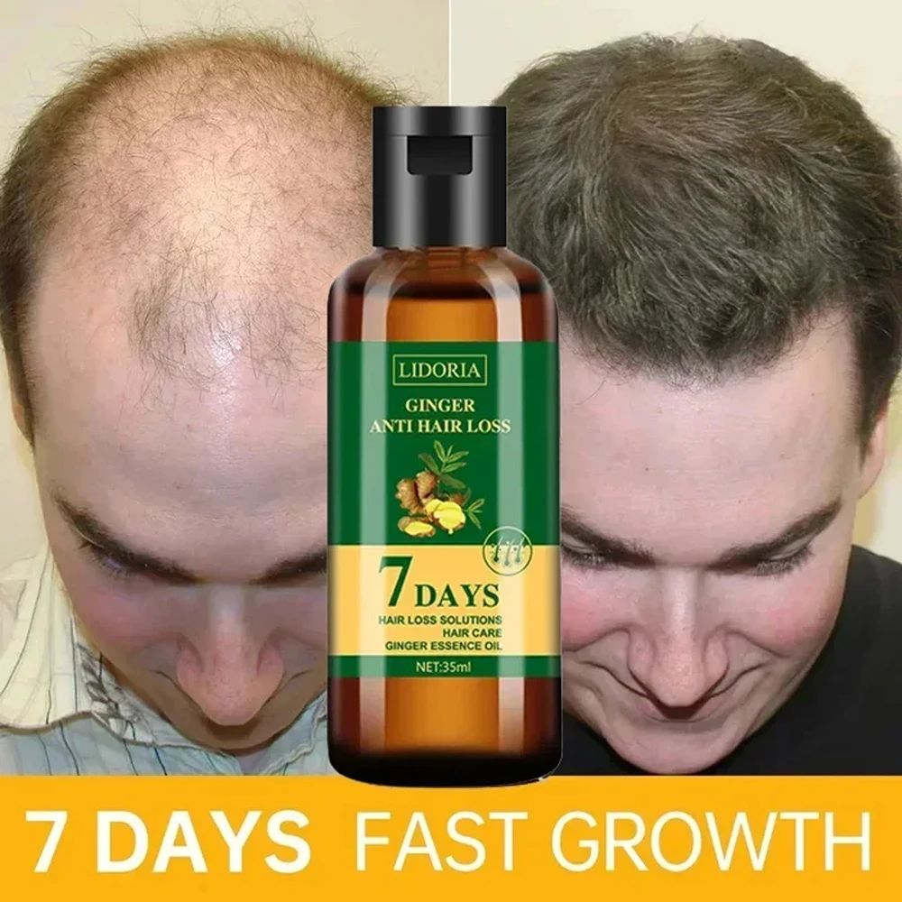 Ginger Hair Growth Essential Oil Anti-loss Hair Regrowth Serum Fast Growth Prevent Baldness Treatment Alopecia Hair Health Care