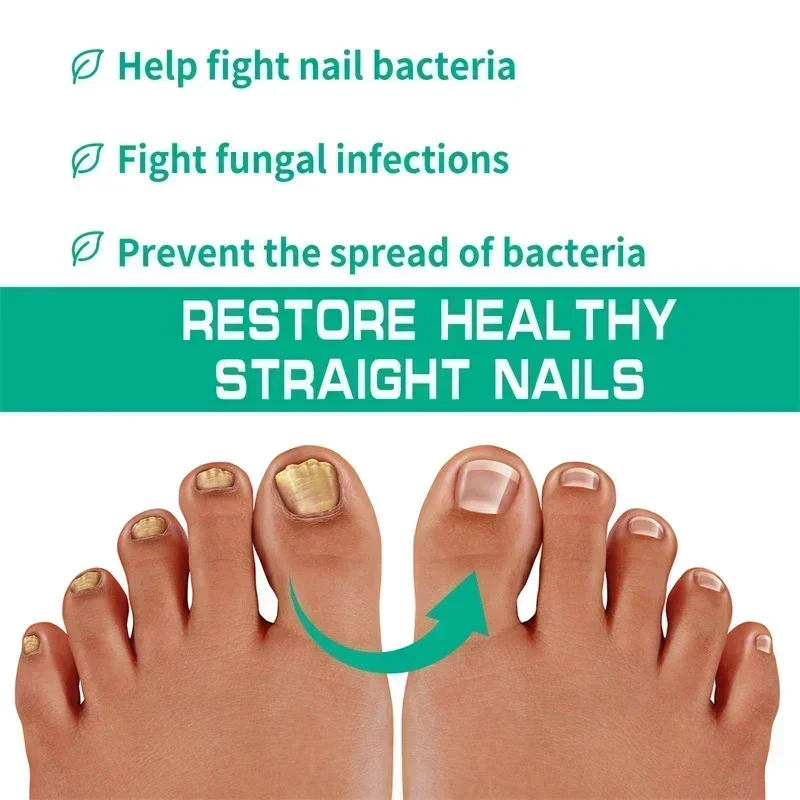 Soro para tratamento de fungos nas unhas, produtos para reparo de fungos dos pés, gel para remoção de cuidados com as mãos e pés, anti-infecção, paroníquia, onicomicose