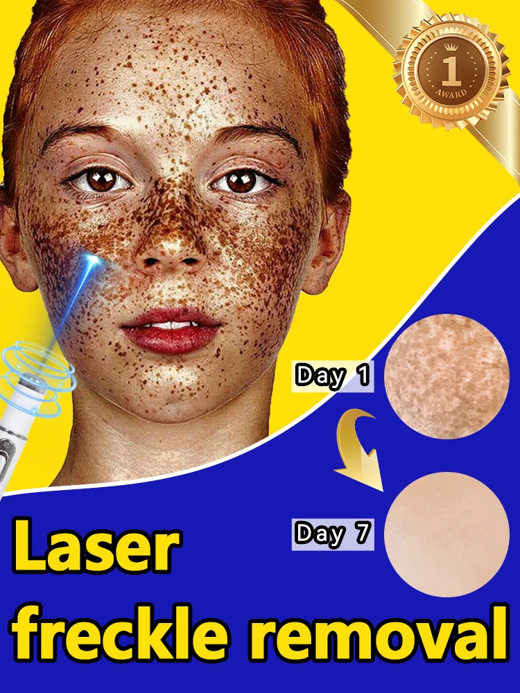 Laser highly effective repair of facial freckles