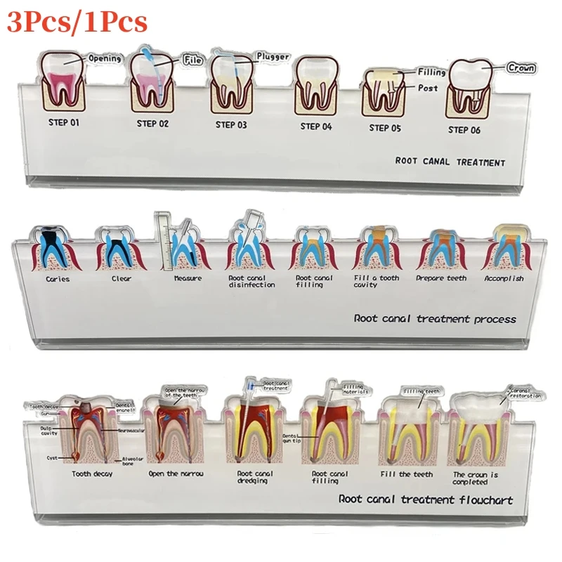 

Dental Endo Root Canal Treatment Process Flowchart Endodontic Process Guide Dental Demonstration Teaching Model Dentist Gift