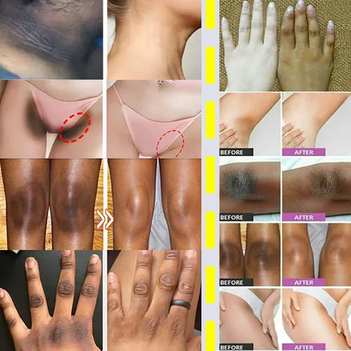 Imagen 2 del producto Crema blanqueadora para partes privadas, suero blanqueador para axilas, blanqueador a tope, rodilla, ilumina la parte interior del muslo, partes íntimas, elimina la melanina