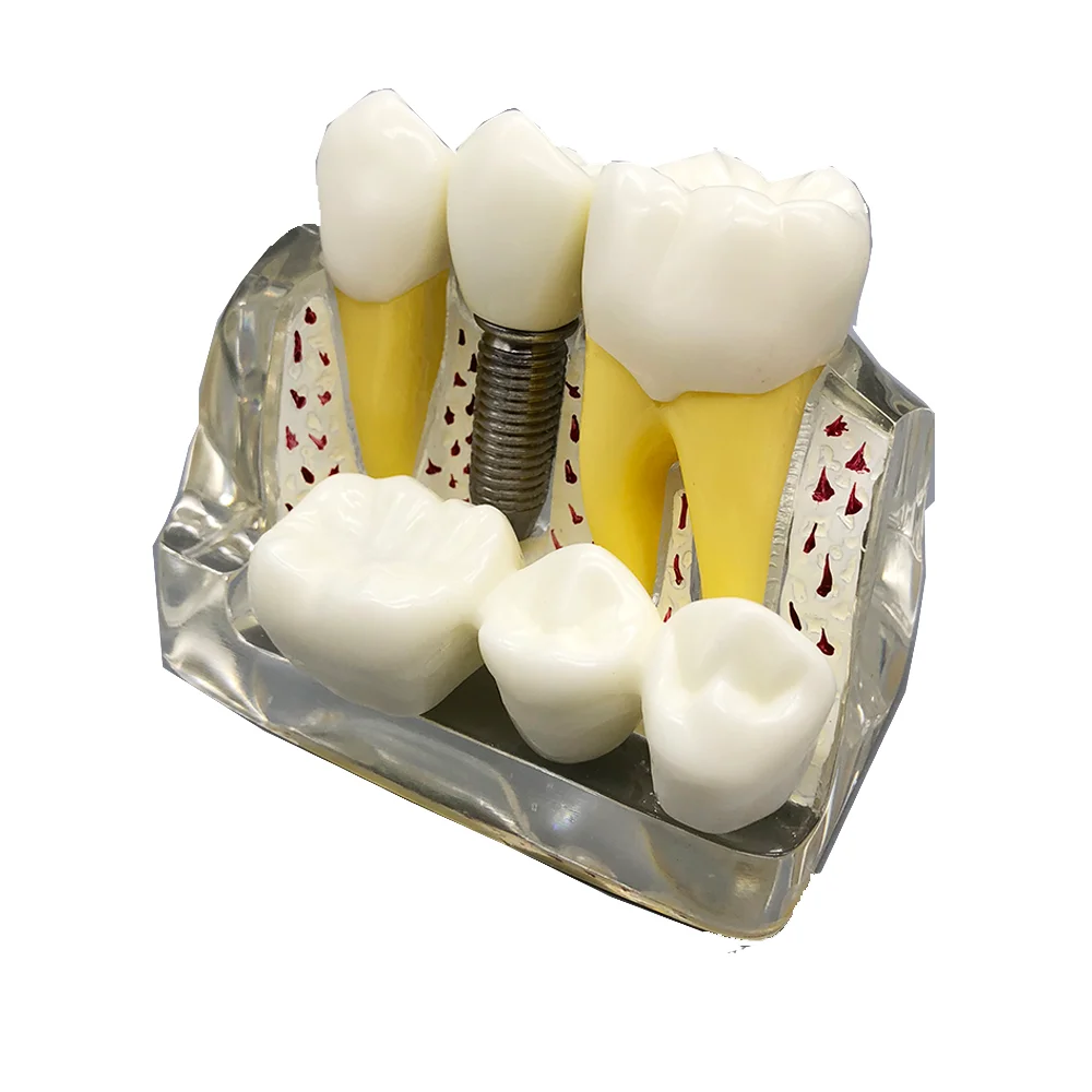 

4 Times Implant Teeth Model With Crown & Bridge Removable Implant Analysis Crown Bridge Removable Model Teaching Demonstration