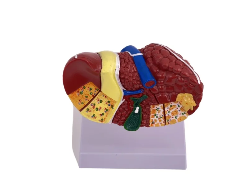 

High-quality color liver models with common clinicopathological features, doctor-patient communication models used by physicians