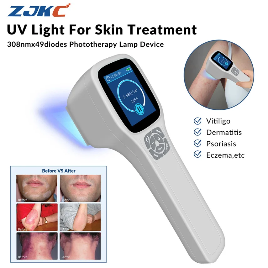 

308nm Excimer System Uv Light for Vitiligo Treatment Psoriasis Eczema Ultraviolet Blue Light Therapy Device for Home Use Grey