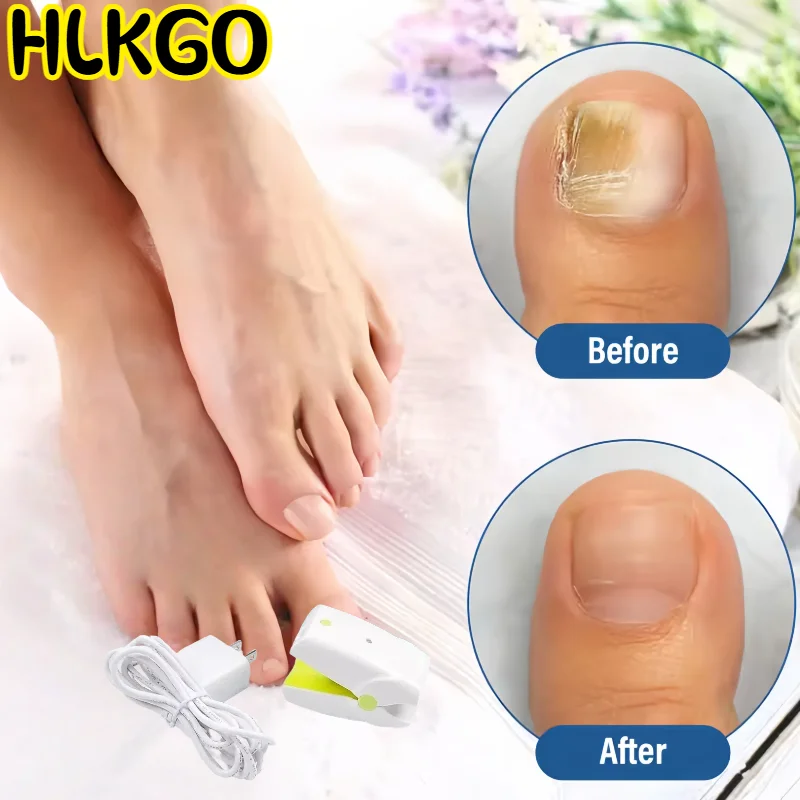 

Professional Nail Fungus Laser Treatment Device, Toenail Fungus Removal Equipment, Clinical Grade Laser Therapy for Onychomycosi