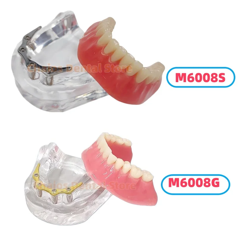 1Pcs Dental Implant Teeth Model With 4 Implant Screws Connecting Bar Retained Implant Overdenture Oral Teaching Typodont Model