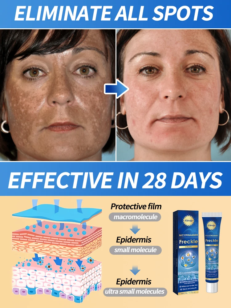 Remove freckles and whiten the skin, lighten and brighten facial dark spots