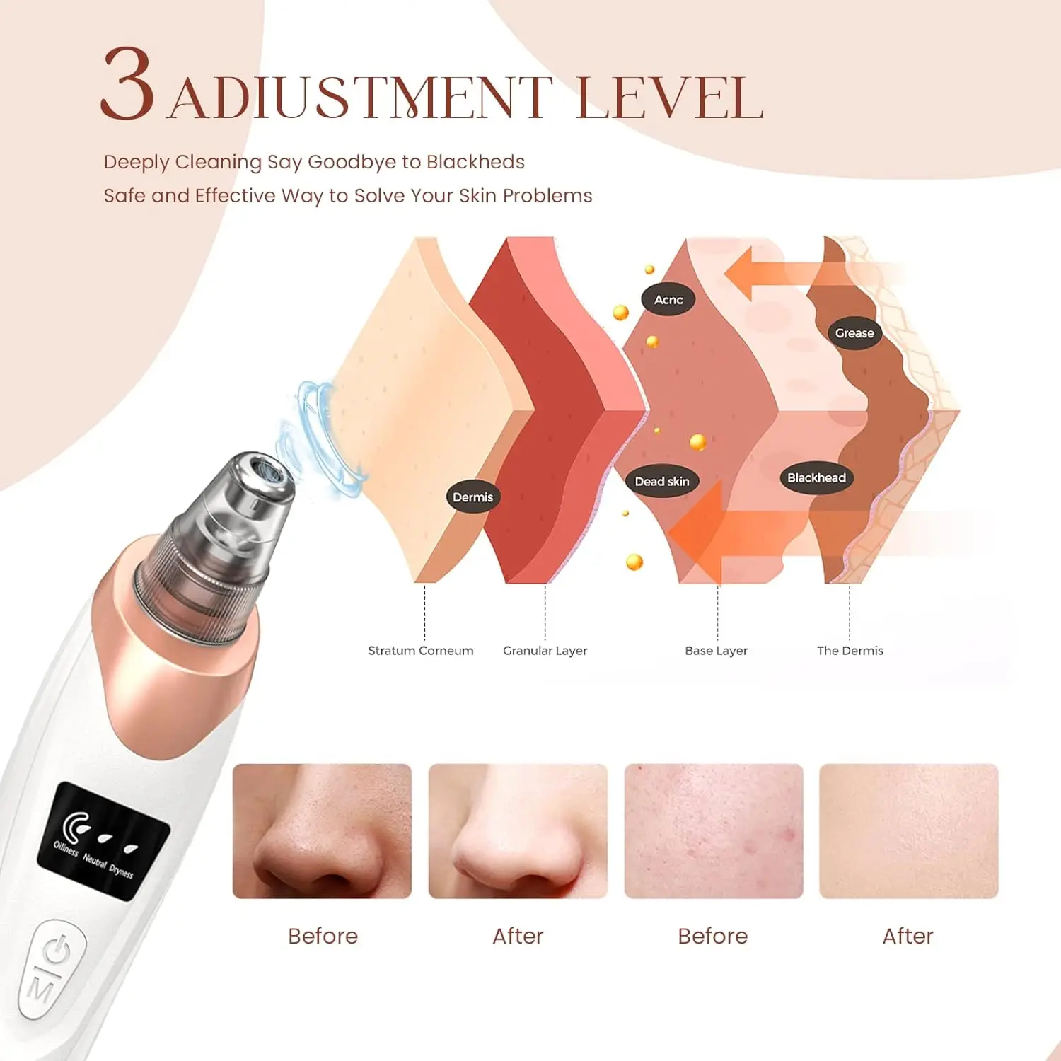 Vacuum Blackhead Remover Dark Dot Spots Pore Cleanser Point Noirs Extractor 5 in 1 Pimple Acne Sebum Sucker Facial Cleaning Tool