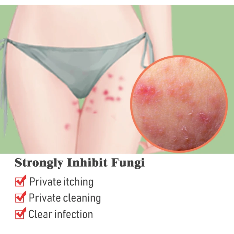 مضاد للجراثيم كريم الأكزيما مرهم إزالة رائحة الجزء الخاص التهاب الجلد المضادة للحكة Tinea Cruris عشب الجلد الطبي الصدفية كريم