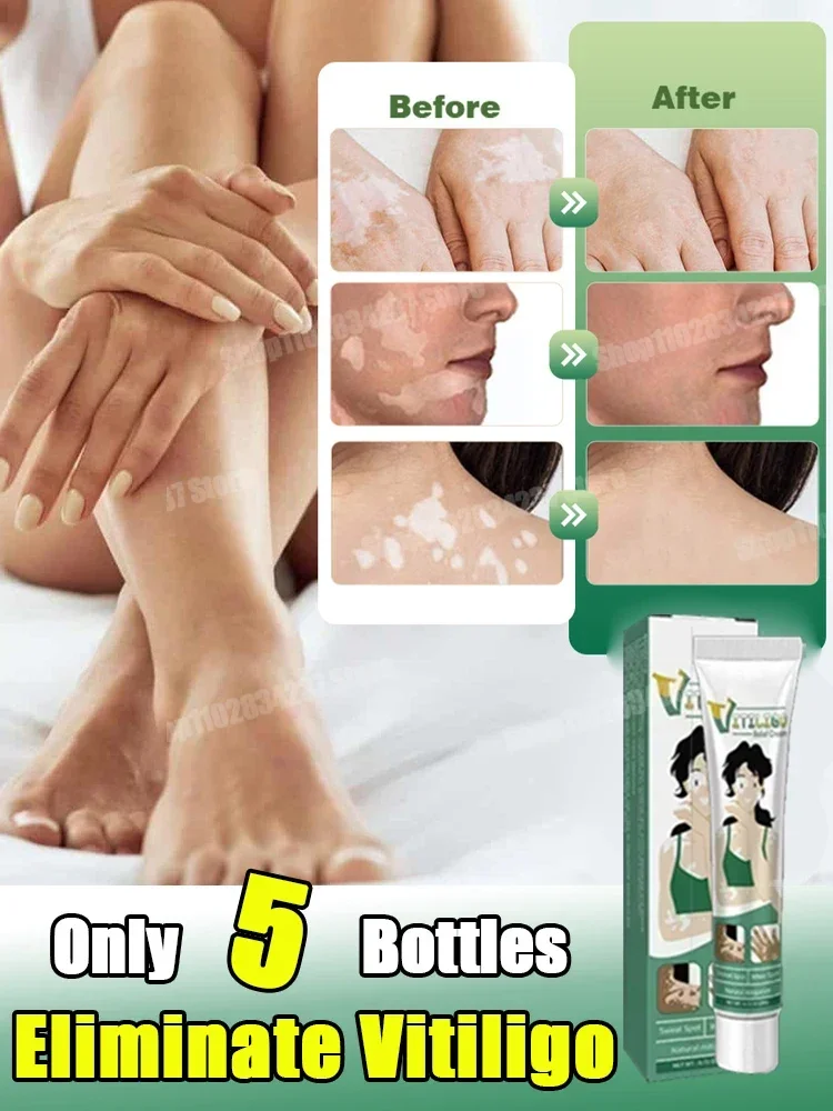 Vitiligo Removal Cream White Spot Cream Skin care cream vitiligo skin Sweat spot Reduce white spots Skin care