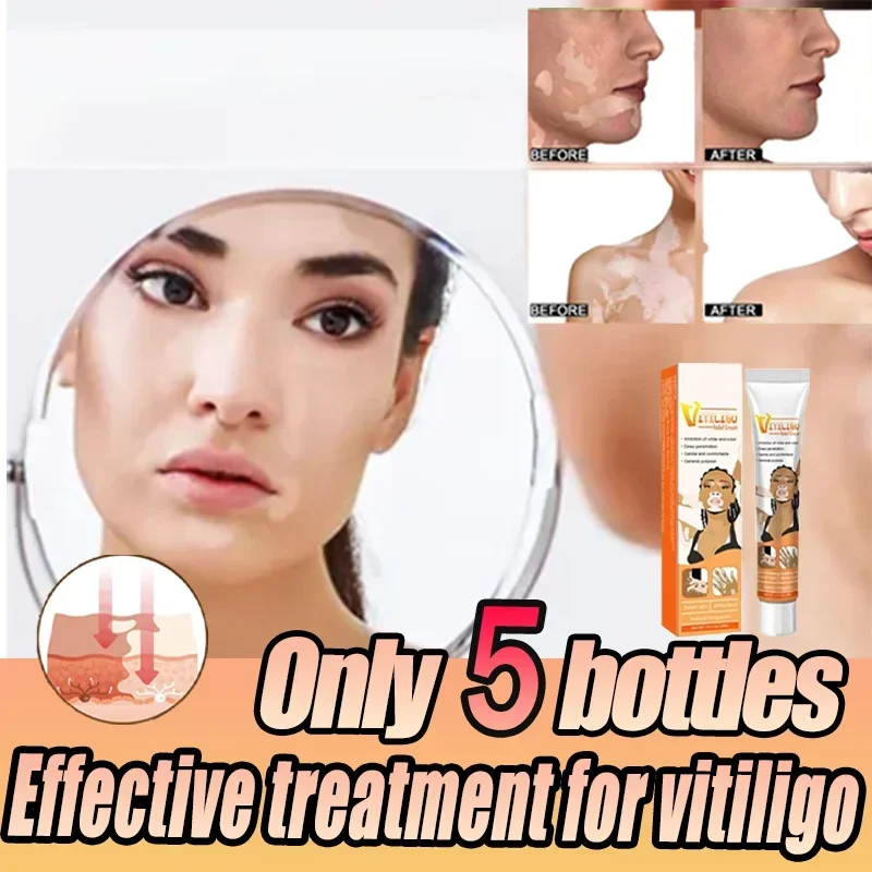 

Effectively Remove White Spot Removal Skin Vitiligo Eliminate Vitiligo Body Skin Care