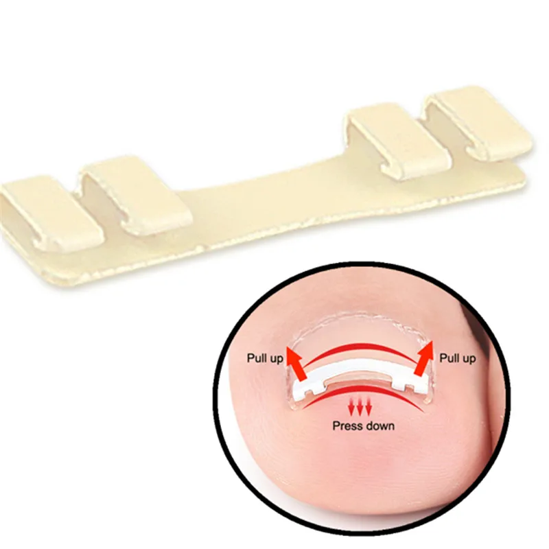 내성발톱 치료용 1개, 내성발톱 교정용 탄력 패치 스티커, 발톱 교정 클립, 발 관리 도구