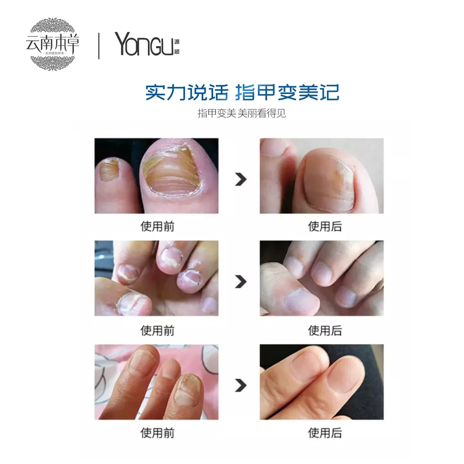 biological care solution to remove onychomycosis care solution nail care solution onychomycosis pen nutrient