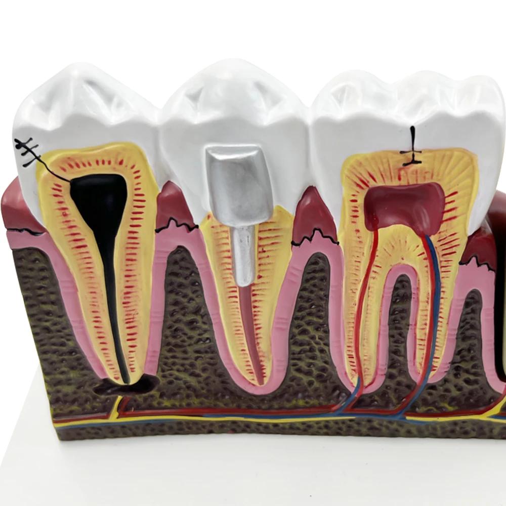 Patologie stomatologiczne anatomiczny Model struktury do nauczania badania leczenia kanałowego demonstracyjna dentysta dla pacjenta