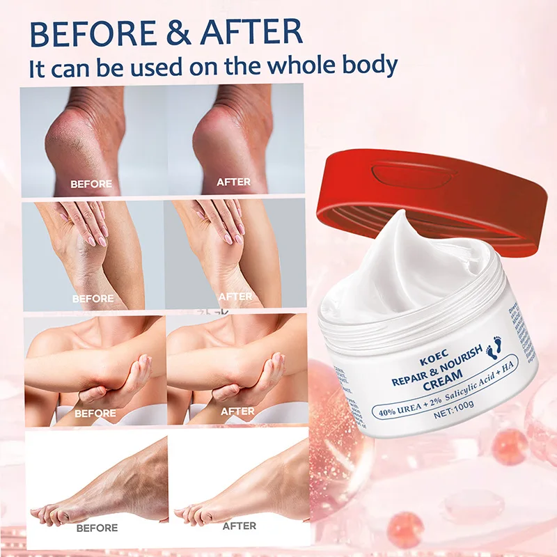 100g KOEC 40% Urea Repair Nourish Foot Cream Moisturizing Softening Exfoiliating Salicylic Acid Hyaluronic Acid Squalane Vitamin