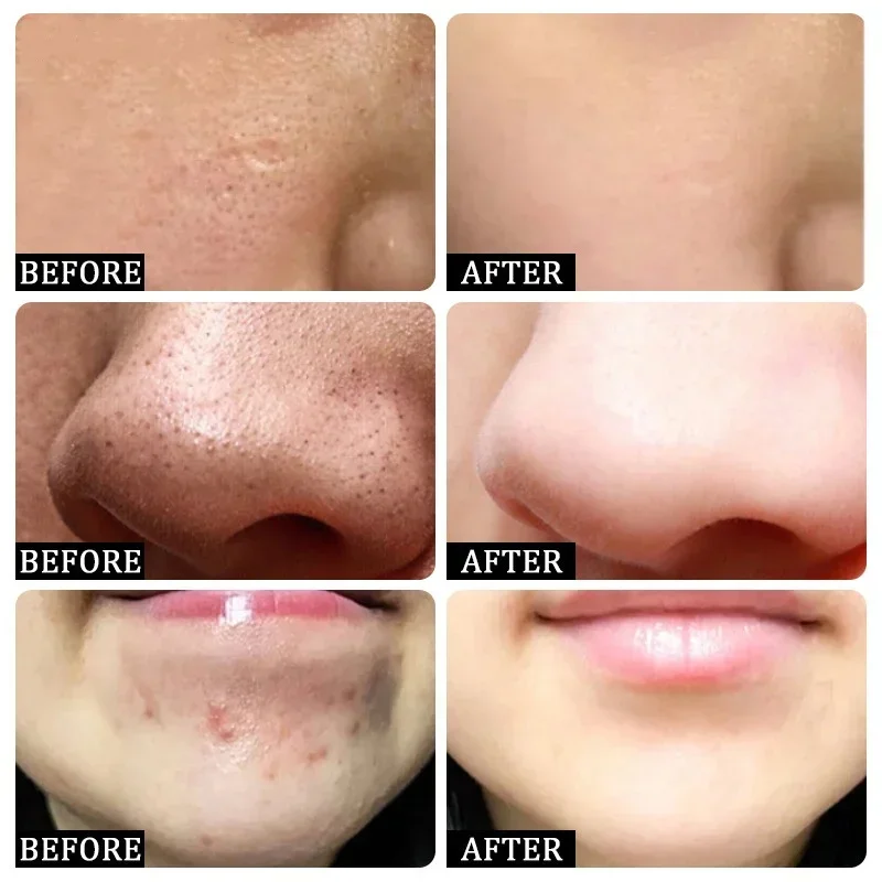 Salicylic Acid Pore Clearing Cream Shrink Pores Remove Blackheads Acne Brighten Moisturizing Smooth Skin Care Korean Products