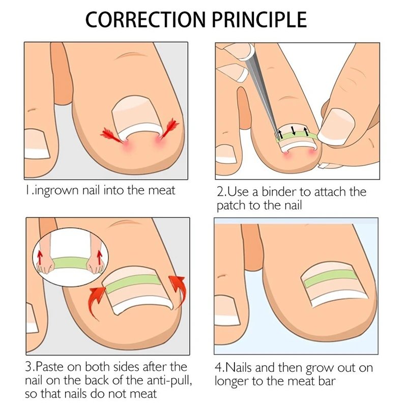 Paroníquia-Ingrown Toenail Pedicure Ferramenta, Clipe de alisamento, Curvo B Brace, Grosso Paroníquia Ferramenta Correção, Hot, Garrafa, 10Pcs