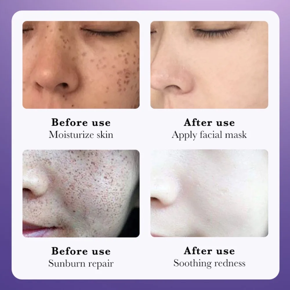 Nicotinamide Whitening Cream Remove Melasma Fade Color Spots Freckles Cream Brightening Skin Hydration Moisturize Cream Women