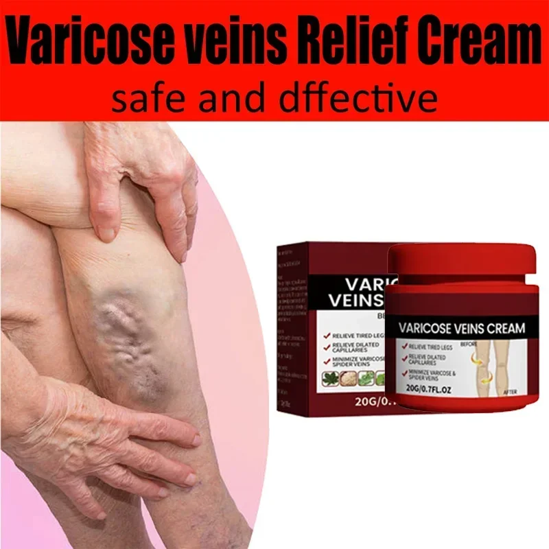 

Varicose Veins Ointment 100% Original Vasculitis Phlebitis Spider Treatment Cream Medical Herbal Plaster Skin Care