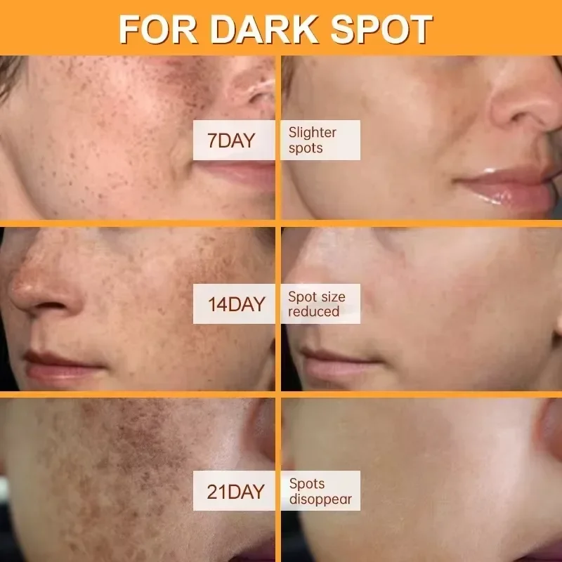 Whitening Freckles Face Cream Removal Melasma Dark Spots Corrector Lighten Melanin Pigmentation Brighten Anti-Aging Beauty Care