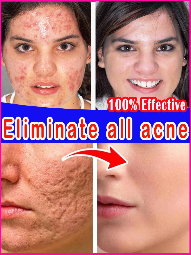 

Acne Cream Remedy Anti Marks Serum