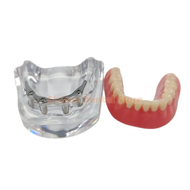 1Pcs Dental Implant Teeth Model With 4 Implant Screws Connecting Bar Retained Implant Overdenture Oral Teaching Typodont Model